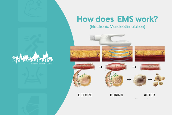 EMS treatment for post pregnancy weight loss treatment Virginia Water