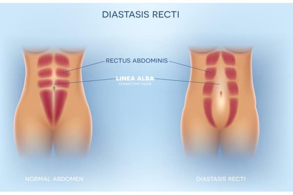 What Non-Surgical Options Are Available for Diastasis Recti Virginia Water?