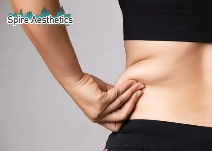 Image of woman pinching fat on their hips Virginia Water. Fat Freezing treatment