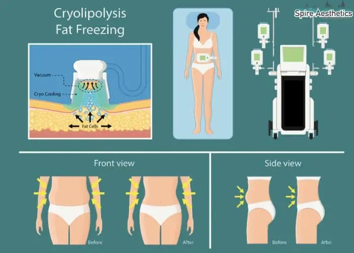 Fat freezing treatment Virginia Water benefits for competitions to remove stubborn fat deposits.