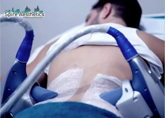 Man having fat freezing treatment done on love handles before a competitions Virginia Water to create a sculpted look.