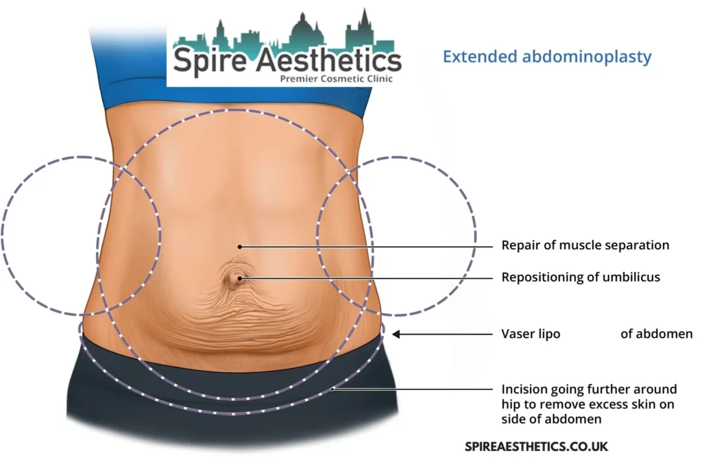 Understanding Loose Skin After Gastric Band Virginia Water Surgery and HIFU Treatment 
