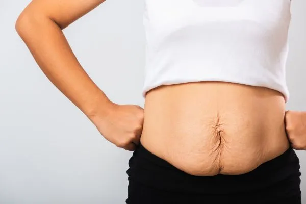 Image of a woman's stomach after weight loss with sagging skin following a gastric band Virginia Water