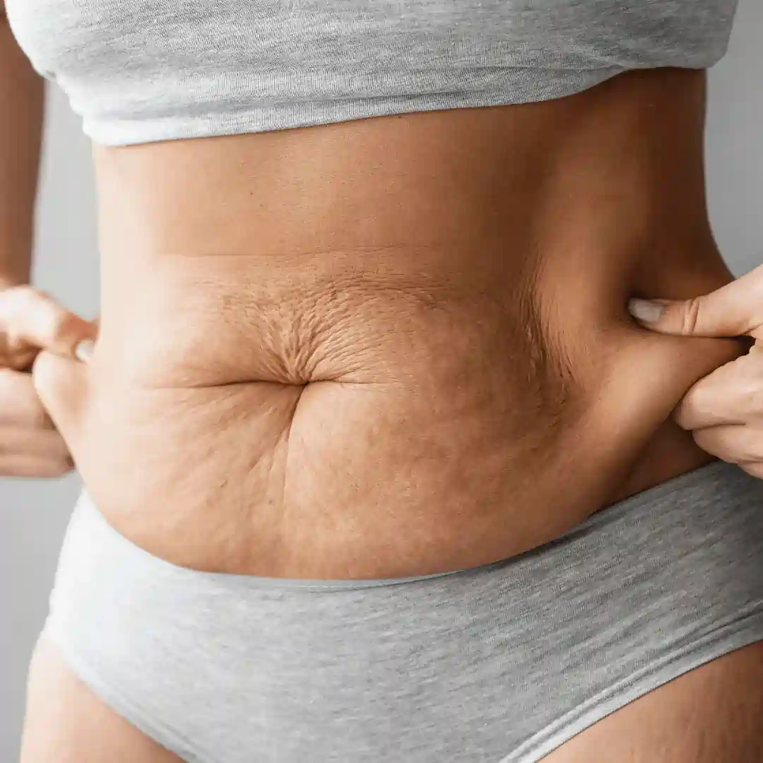 Is It Normal to Have Loose Skin After Pregnancy Virginia Water?
