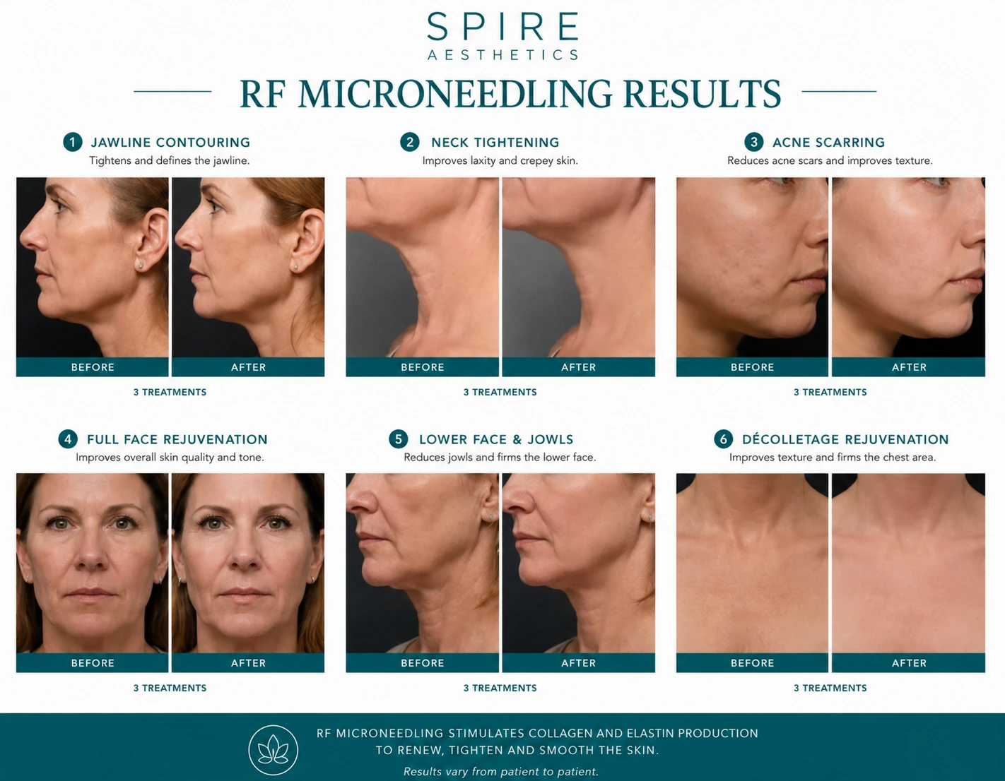 RF Microneedling Skin tightening Virginia Water results
