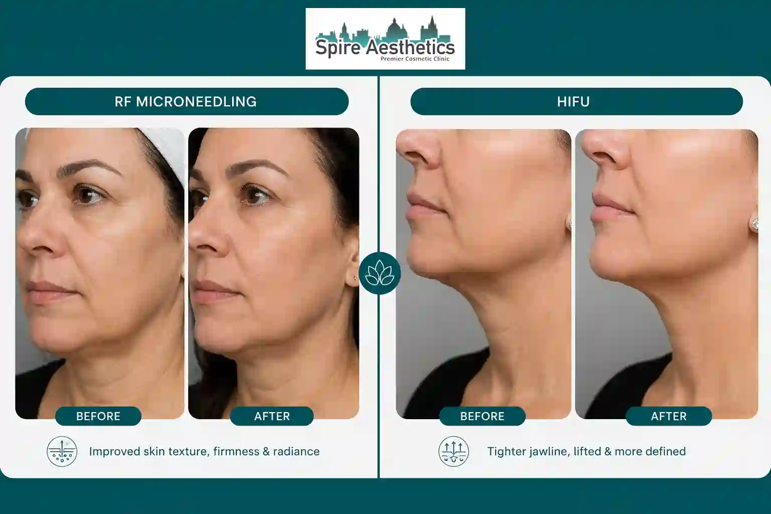 Can RF Microneedling and HIFU Be Combined Virginia Water?
