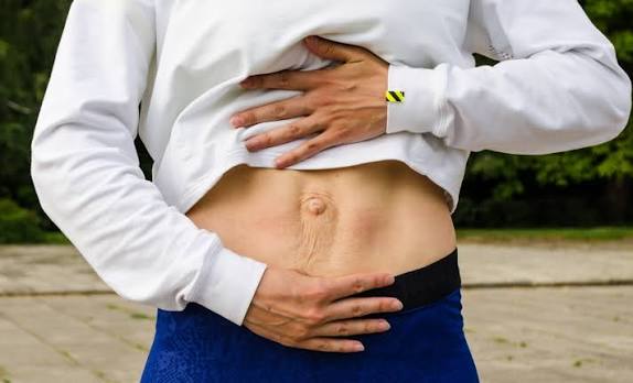When Could Diastasis Recti Be the Missing Piece of the Puzzle Virginia Water?