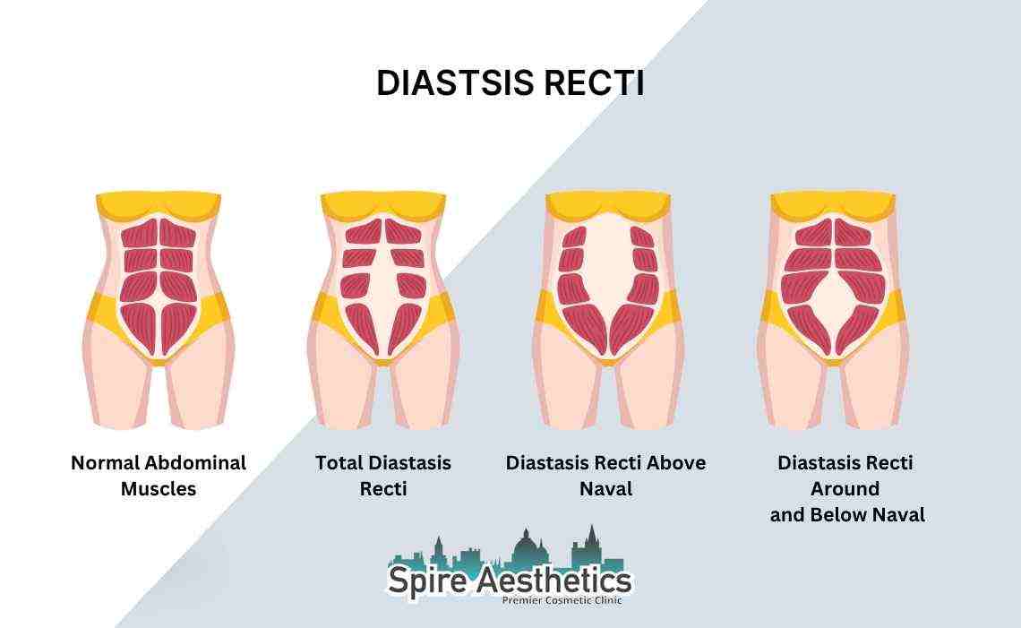 Is Non-Surgical Diastasis Recti Treatment Right for You? Common Concerns Answered Virginia Water